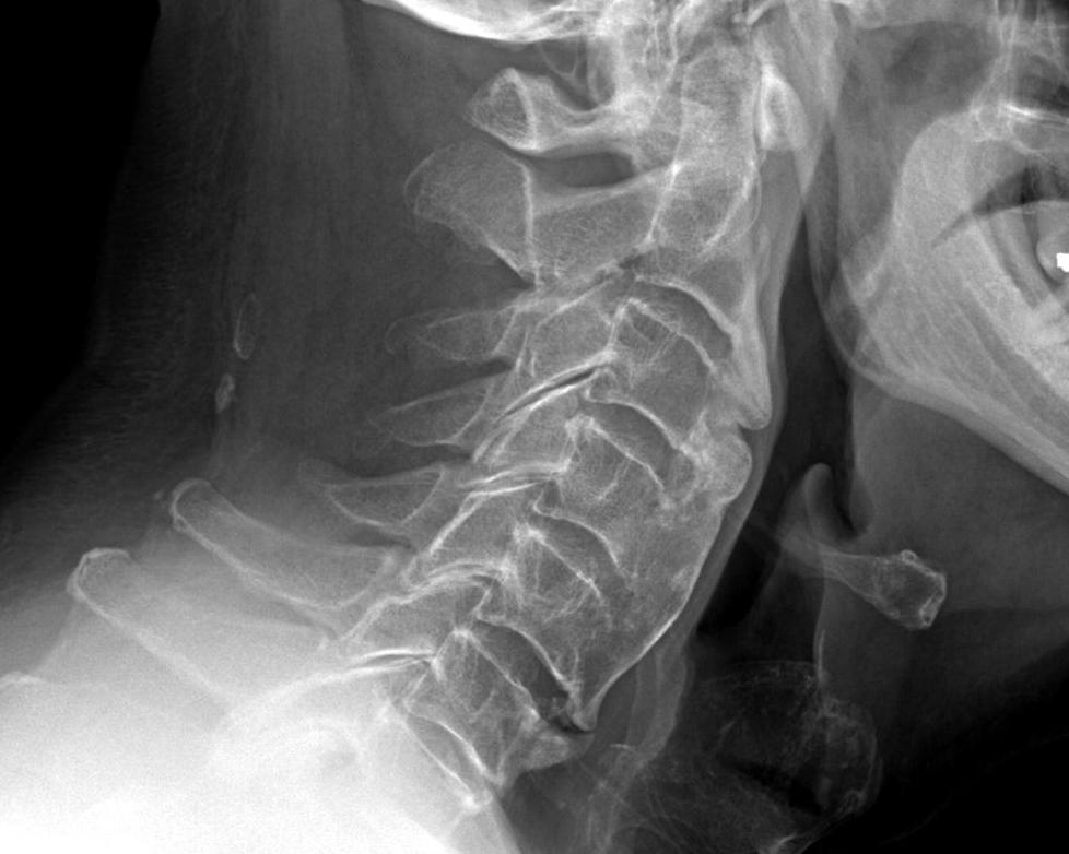 DISH Cervical Spine Lateral